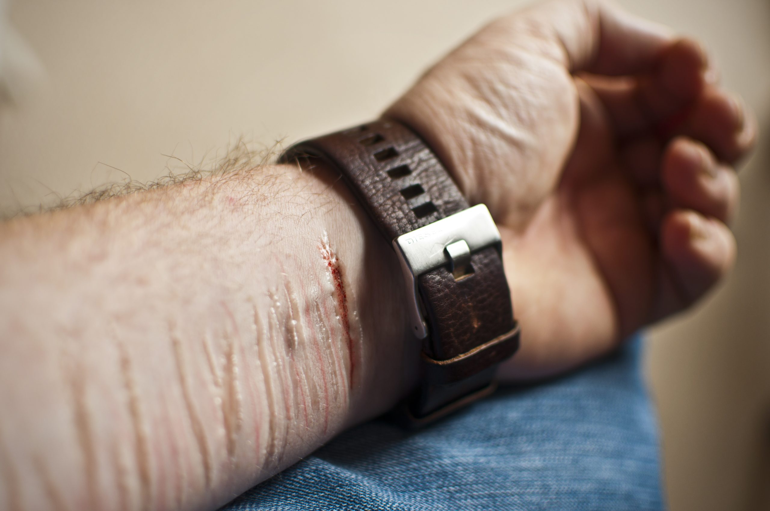 Self Harm (NSFW)